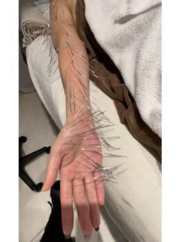 ランスソア(L'ins soi)/鍼 ルート鍼