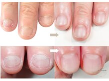 ネイルサロン グリーム(nail salon gleam)の雰囲気（深爪矯正/噛み爪※医療関係のお客様も多くご来店されてます）