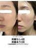【剥けるハーブピーリング】ニキビケアフェイシャル［凸凹肌］