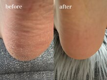 爪のいろは/つるすべ踵♪足裏フットケア！