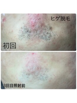 エヌアール(NR)/men's ヒゲ脱毛