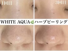 ホワイトアクア 京橋店(WHITE AQUA)/毛穴洗浄/3回ビフォーアフター
