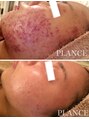 プランス 渋谷(PLANCE)&nbsp;ニキビケア 渋谷