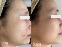 サロンドジェシカ(salon de Jessica)/お顔脱毛＋カーボキシーパック