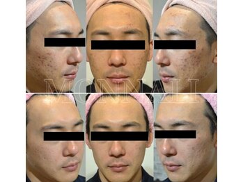 エングロー 錦糸町店(Englow)/【脱・ニキビ】ハーブピーリング