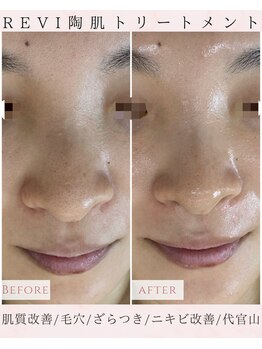 ルリエベル(Relier Belle)/毛穴汚れざらつきにはハーブ♪