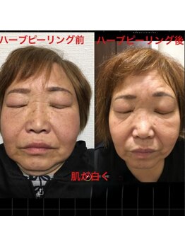 キッカ 梅田天六(Kikka)/シミ フェイシャル