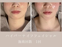 ココロミ(cocoromi)/ハイパーナイフフェイシャル