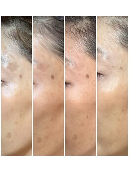 チェシル(CHESIL)/ビフォーアフター