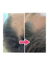 カブール 町田/おでこが広くなってきたら