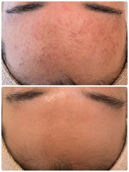 ニコリ(Nicori)/肌荒れ卒業☆