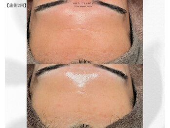 アン ビューティー(ann beauty)/施術2回【症例写真】20代