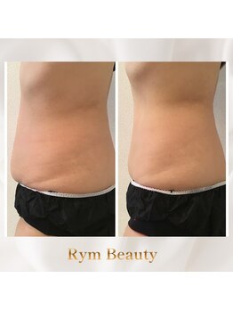 リム ビューティー(RYM BEAUTY)/最新超音波でお腹ケア