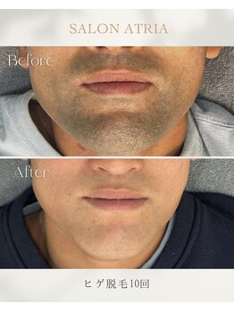 アトリア(ATRIA)/ヒゲ脱毛