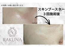 ラクナ(RAKUNA)/韓国美容/肌管理/水光白玉肌