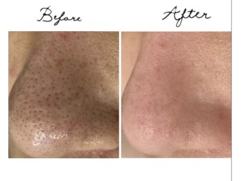 アリュール(ALLURE)の写真/強力《ニキビ＆毛穴同時改善》通いやすい価格No.1◇光×プラズマ《平日割￥6,500》ハイドロ付きも大人気◇