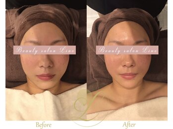 リノ(Lino)/1回の施術でここまでの変化☆