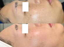 ロイ 初生店(LOI)/ハーブ×プラズマ