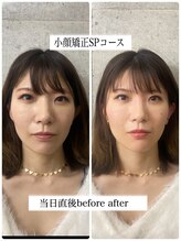 セリア(CELIA)/小顔矯正/小顔//面長/エラ張り