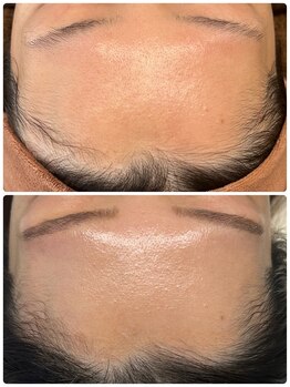 キキ(KIKI)/ハーブピーリング