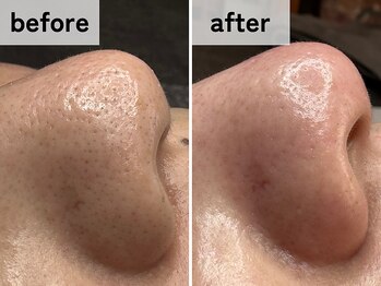 エアル(earu.)/BA|毛穴ケア|ピーリング|高円寺