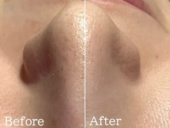 ルナステラ 金沢店/ハイドロ毛穴洗浄