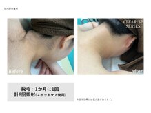 アイラッシュメイ(eyelash May)/襟足脱毛 ¥4,000