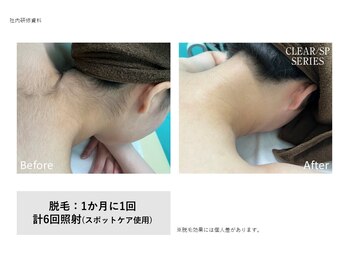 アイラッシュメイ(eyelash May)/襟足脱毛 ¥4,000