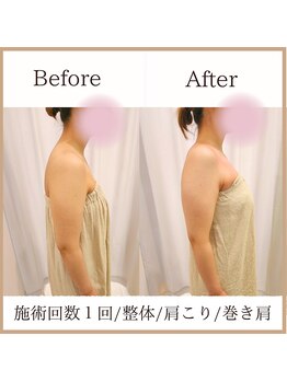 サロンルーチェ(Salon Luce)/ビフォーアフター/施術回数1回