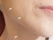 ル キヤ アイスペシャリテ ハービスENT店/不要な角栓・角質を除去☆