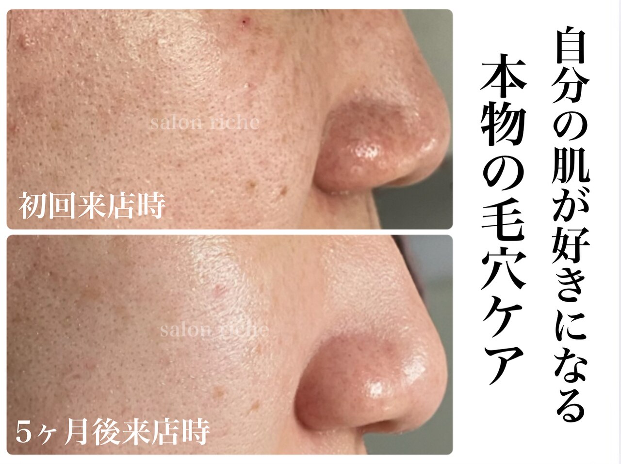 松山市で毛穴ケアが人気のエステサロン｜ホットペッパービューティー