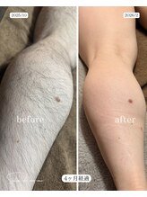 サロンド モーモ(SALON de mo-mo)/４ヶ月でこの結果：脚