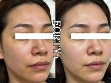 フォーティープラス(FORTY+)/施術事例