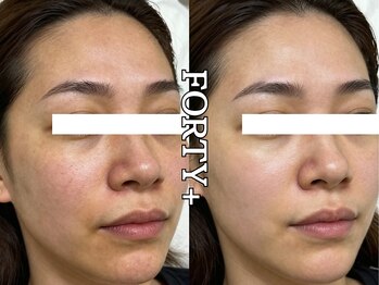 フォーティープラス(FORTY+)/施術事例