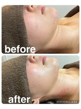 ギンザアール(GINZA R.)/小顔矯正