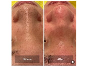 ビーフリー(Be Free)/毛穴洗浄