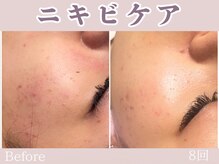 レッド(RED)/ニキビケア