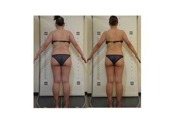 アイリスエステサロン うるま江洲店/確実にスッキリしてきました