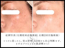 韓国肌管理室 ソア(soa)/【シミ等色素管理症例】