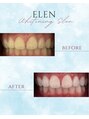 エレン 高槻店(ELEN)&nbsp;セルフホワイトニング/大阪/高槻/茨木/小顔/美白