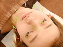 三和旭が丘院/プレミアム美容鍼