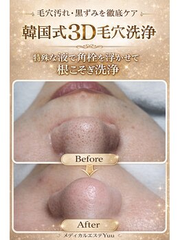 メディカルエステ ユウ(Yuu)の写真/韓国肌管理「韓国式３D毛穴洗浄」「韓国セラピール」「ララピール」「l韓国漢方ハーブ」で毛穴レス韓流肌に