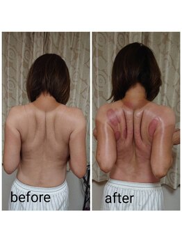 トータルビューティーサロン ポカポカ(poca poca)/ファンクショナルカッピング