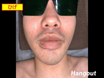 ハングアウト(HANGOUT)/【久留米メンズ脱毛】ヒゲ脱毛前