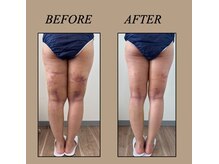 ファミーユ 新宿店/【術後ケア】インディバ