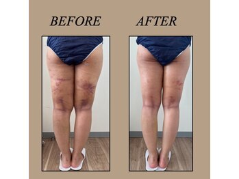 ファミーユ 新宿店/【術後ケア】インディバ