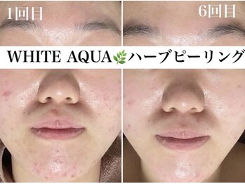 ホワイトアクア 京橋店(WHITE AQUA)/ハーブピーリング/ニキビケア