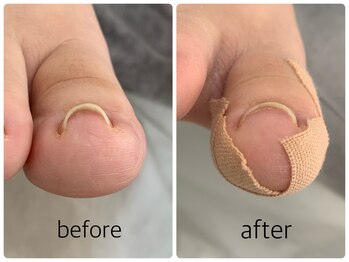 ネイルアンドアイラッシュ アヴィ(Nail and Eyelash A'vi)/巻爪補正