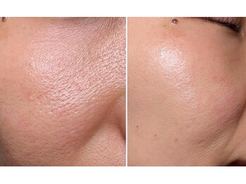 アネモネ(ANEMONE)/生エクソソーム