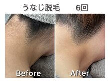 ナルシス/【脱毛】6回の変化★